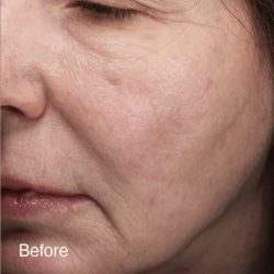 Vivace Ultra Before & After Patient #12801