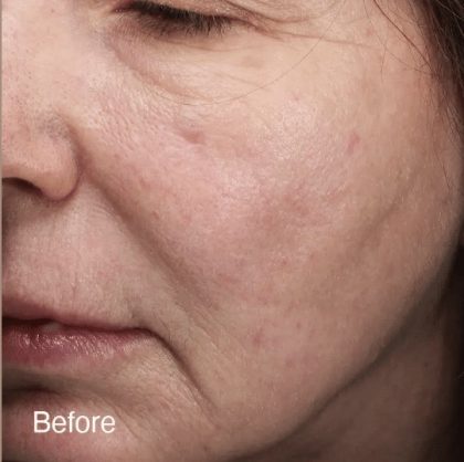 Vivace Ultra Before & After Patient #12801