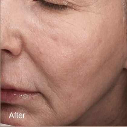 Vivace Ultra Before & After Patient #12801