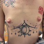 Breast Augmentation Before & After Patient #13696