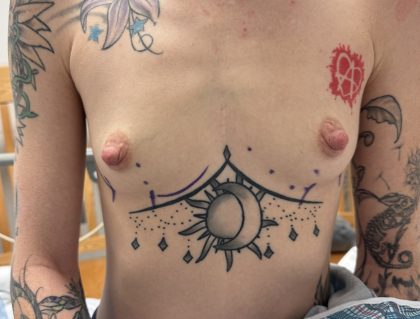 Breast Augmentation Before & After Patient #13696