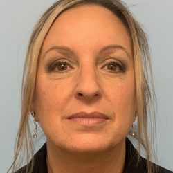 Neck Lift Before & After Patient #13703