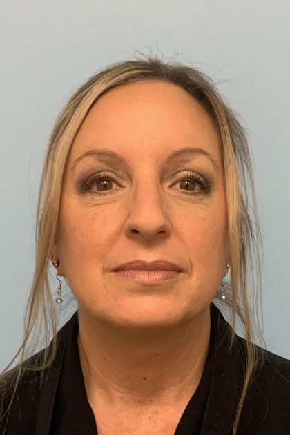 Neck Lift Before & After Patient #13703