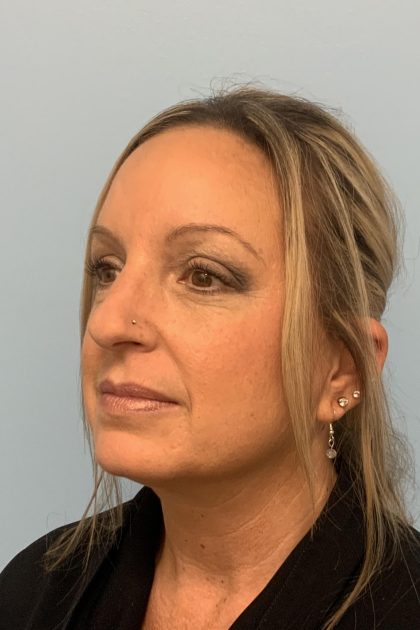 Neck Lift Before & After Patient #13703