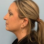 Neck Lift Before & After Patient #13703