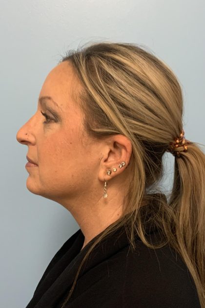 Neck Lift Before & After Patient #13703