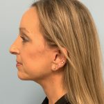 Neck Lift Before & After Patient #13703