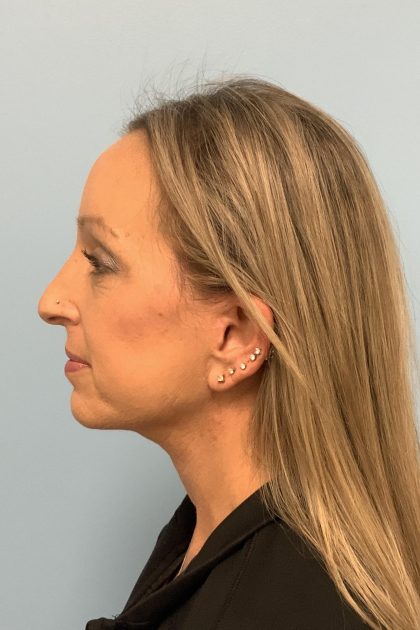 Neck Lift Before & After Patient #13703