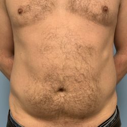 Renuvion Before & After Patient #13724