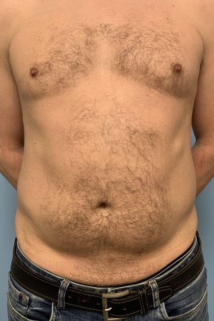 Renuvion Before & After Patient #13724