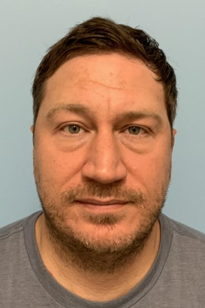 Renuvion / Vaser of neck Before & After Patient #13723