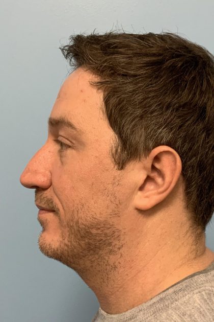 Renuvion / Vaser of neck Before & After Patient #13723