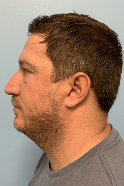 Renuvion / Vaser of neck Before & After Patient #13723