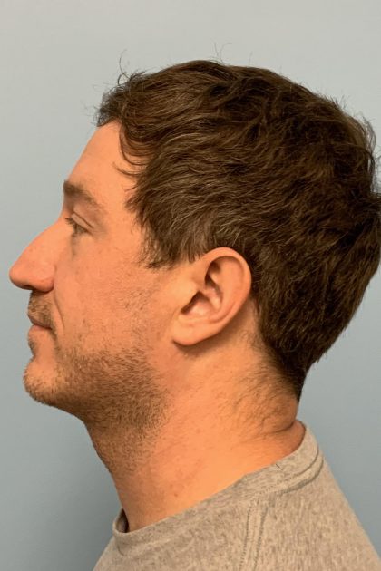 Renuvion / Vaser of neck Before & After Patient #13723