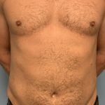 Renuvion Before & After Patient #13724