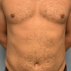 Renuvion Before & After Patient #13724