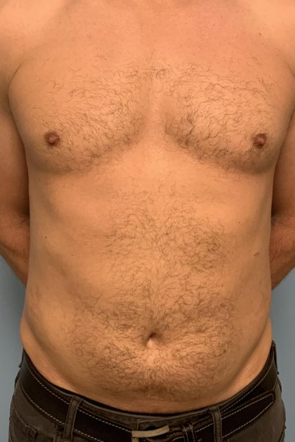 Renuvion Before & After Patient #13724