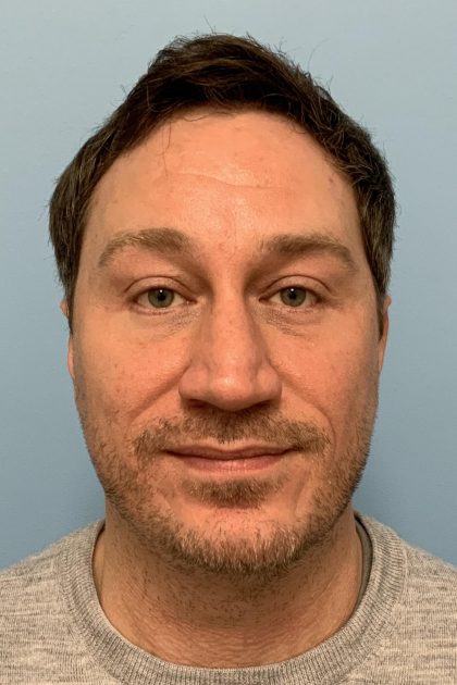 Renuvion / Vaser of neck Before & After Patient #13723