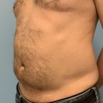 Renuvion Before & After Patient #13724