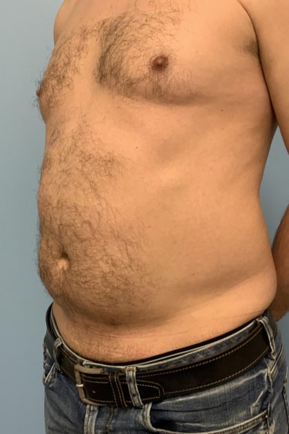Renuvion Before & After Patient #13724