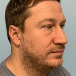 Renuvion / Vaser of neck Before & After Patient #13723
