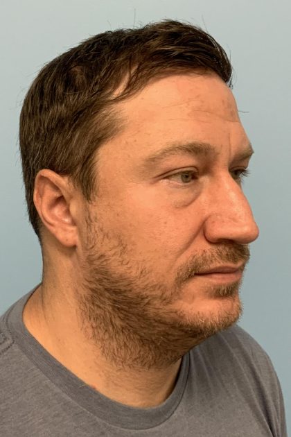 Renuvion / Vaser of neck Before & After Patient #13723
