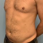 Renuvion Before & After Patient #13724
