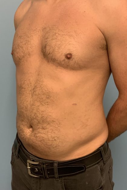 Renuvion Before & After Patient #13724