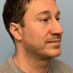 Renuvion / Vaser of neck Before & After Patient #13723