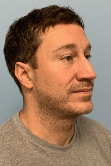 Renuvion / Vaser of neck Before & After Patient #13723