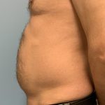 Renuvion Before & After Patient #13724