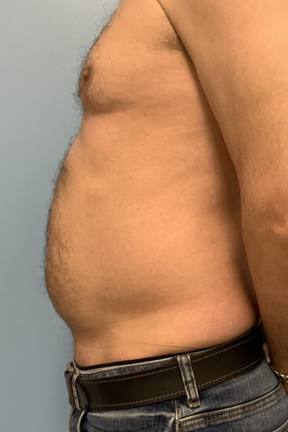 Renuvion Before & After Patient #13724
