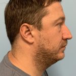 Renuvion / Vaser of neck Before & After Patient #13723