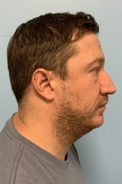Renuvion / Vaser of neck Before & After Patient #13723