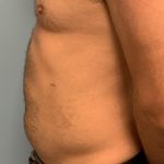 Renuvion Before & After Patient #13724
