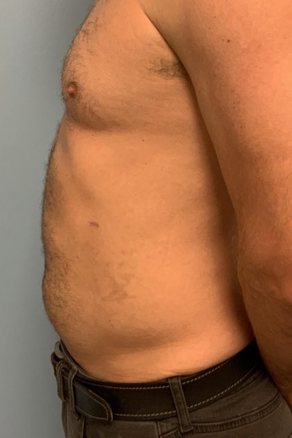 Renuvion Before & After Patient #13724