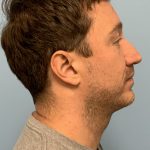 Renuvion / Vaser of neck Before & After Patient #13723