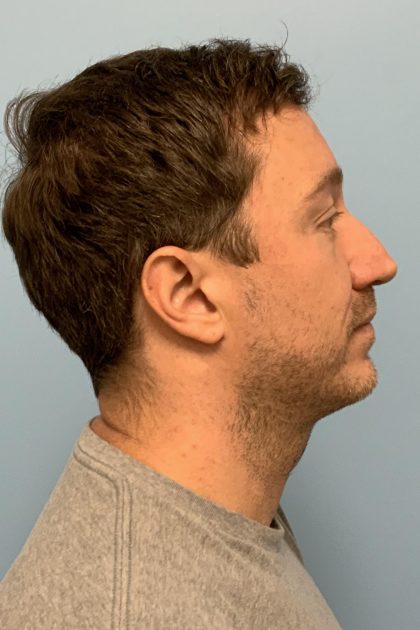 Renuvion / Vaser of neck Before & After Patient #13723