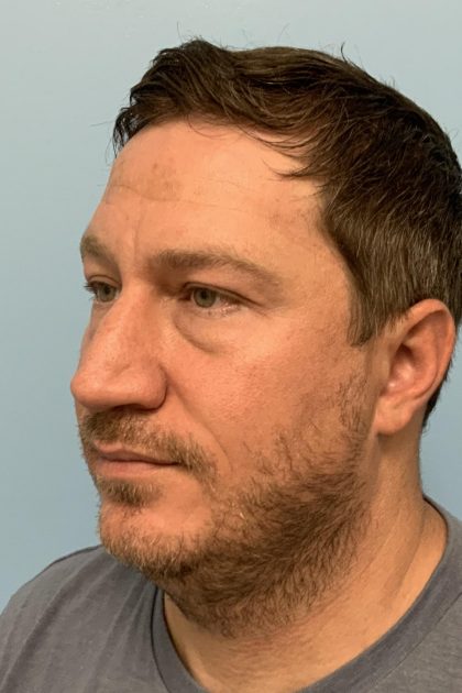Renuvion / Vaser of neck Before & After Patient #13723