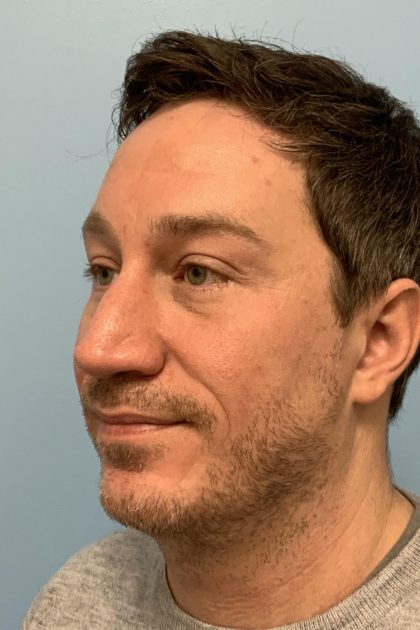 Renuvion / Vaser of neck Before & After Patient #13723