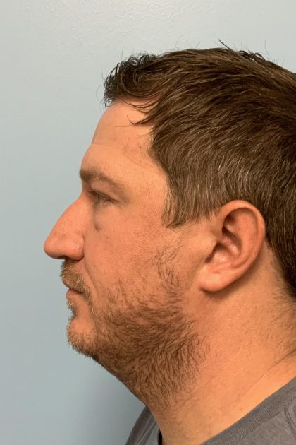 Renuvion / Vaser of neck Before & After Patient #13723