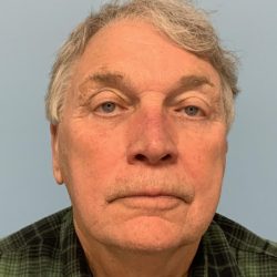 Upper Blepharoplasty Before & After Patient #13772
