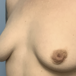 Inverted Nipple Repair (Papuloplasty) Before & After Patient #13786