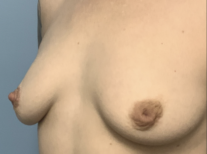 Inverted Nipple Repair (Papuloplasty) Before & After Patient #13786