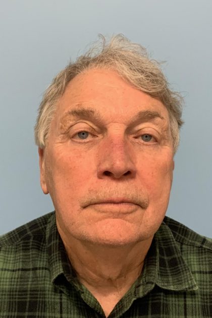 Upper Blepharoplasty Before & After Patient #13772