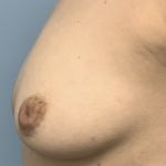 Inverted Nipple Repair (Papuloplasty) Before & After Patient #13786
