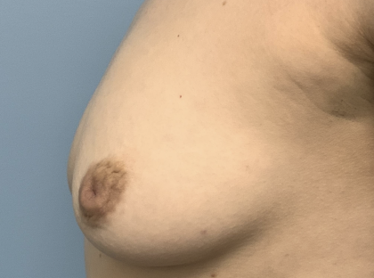 Inverted Nipple Repair (Papuloplasty) Before & After Patient #13786