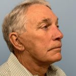 Upper Blepharoplasty Before & After Patient #13772