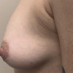 Inverted Nipple Repair (Papuloplasty) Before & After Patient #13786