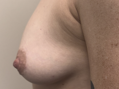 Inverted Nipple Repair (Papuloplasty) Before & After Patient #13786